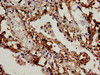 Immunocytochemistry analysis of human lung cancer using CSB-PA002615LA01HU at dilution of 1:100
