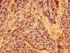 Immunohistochemistry of paraffin-embedded human ovarian cancer using CSB-PA003434LA01HU at dilution of 1:100