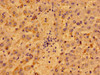 Immunohistochemistry of paraffin-embedded human liver cancer using CSB-PA017326LA01HU at dilution of 1:100 Immunohistochemistry of paraffin-embedded human liver cancer using CSB-PA017326LA01HU at dilution of 1:100