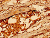 Immunohistochemistry of paraffin-embedded human breast cancer using CSB-PA09479A0Rb at dilution of 1:100