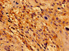 Immunohistochemistry of paraffin-embedded human cervical cancer using CSB-PA619636LA01HU at dilution of 1:100