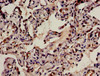 Immunohistochemistry analysis of human lung cancer using CSB-PA880933LA01HU at dilution of 1:100