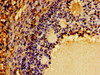 Immunohistochemistry of paraffin-embedded human ovarian cancer using CSB-PA006047LA01HU at dilution of 1:100 Immunohistochemistry of paraffin-embedded human ovarian cancer using CSB-PA006047LA01HU at dilution of 1:100