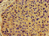 Immunohistochemistry of paraffin-embedded human cervical cancer using CSB-PA006047LA01HU at dilution of 1:100 Immunohistochemistry of paraffin-embedded human cervical cancer using CSB-PA006047LA01HU at dilution of 1:100