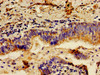 Immunohistochemistry of paraffin-embedded human lung cancer using CSB-PA012827LA01HU at dilution of 1:100 Immunohistochemistry of paraffin-embedded human lung cancer using CSB-PA012827LA01HU at dilution of 1:100