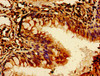 Immunohistochemistry of paraffin-embedded human lung cancer using CSB-PA21119A0Rb at dilution of 1:100