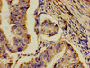 Immunohistochemistry of paraffin-embedded human endometrial cancer using CSB-PA624122LA01HU at dilution of 1:100