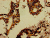 Immunohistochemistry of paraffin-embedded human pancreatic cancer using CSB-PA883361LA01HU at dilution of 1:100