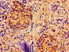 Immunohistochemistry of paraffin-embedded human pancreatic cancer using CSB-PA001053LA01HU at dilution of 1:100