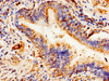 Immunohistochemistry of paraffin-embedded human lung cancer using CSB-PA001068LA01HU at dilution of 1:100