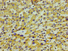 Immunohistochemistry of paraffin-embedded human liver cancer using CSB-PA001917LA01HU at dilution of 1:100