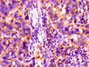 Immunohistochemistry of paraffin-embedded human pancreatic cancer using CSB-PA005279LA01HU at dilution of 1:100