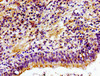 Immunohistochemistry of paraffin-embedded human lung cancer using CSB-PA005353LA01HU at dilution of 1:100