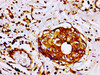 Immunohistochemistry of paraffin-embedded human breast cancer using CSB-PA008724LA01HU at dilution of 1:100