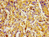 Immunohistochemistry of paraffin-embedded human liver cancer using CSB-PA011861LA01HU at dilution of 1:100