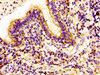 Immunohistochemistry of paraffin-embedded human lung cancer using CSB-PA011922LA01HU at dilution of 1:100