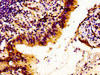 Immunohistochemistry of paraffin-embedded human lung cancer using CSB-PA012730LA01HU at dilution of 1:100