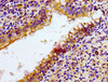 Immunohistochemistry of paraffin-embedded human lung cancer using CSB-PA015551LA01HU at dilution of 1:100