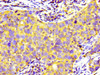 Immunohistochemistry of paraffin-embedded human pancreatic cancer using CSB-PA018739LA01HU at dilution of 1:100