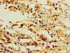 Immunohistochemistry of paraffin-embedded human melanoma using CSB-PA018982LA01HU at dilution of 1:100