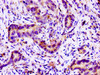 Immunohistochemistry of paraffin-embedded human pancreatic cancer using CSB-PA021381LA01HU at dilution of 1:100