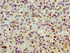 Immunohistochemistry of paraffin-embedded human glioma using CSB-PA021844LA01HU at dilution of 1:100