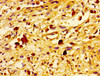 Immunohistochemistry of paraffin-embedded human melanoma using CSB-PA025444LA01HU at dilution of 1:100
