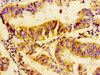 Immunohistochemistry of paraffin-embedded human endometrial cancer using CSB-PA025444LA01HU at dilution of 1:100