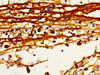 Immunohistochemistry of paraffin-embedded human melanoma using CSB-PA13409A0Rb at dilution of 1:100