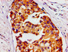Immunohistochemistry of paraffin-embedded human breast cancer using CSB-PA14189A0Rb at dilution of 1:100