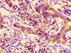 Immunohistochemistry of paraffin-embedded human pancreatic cancer using CSB-PA341920LA01HU at dilution of 1:100