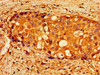 Immunohistochemistry of paraffin-embedded human breast cancer using CSB-PA614901LA01HU at dilution of 1:100