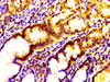 Immunohistochemistry of paraffin-embedded human gastric cancer using CSB-PA848386LA01HU at dilution of 1:100