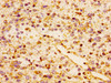 Immunohistochemistry of paraffin-embedded human glioma using CSB-PA856406LA01HU at dilution of 1:100