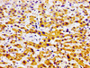 Immunohistochemistry of paraffin-embedded human liver cancer using CSB-PA856610LA01HU at dilution of 1:100