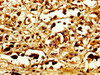 Immunohistochemistry of paraffin-embedded human melanoma using CSB-PA892321LA01HU at dilution of 1: 100