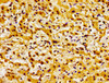 Immunohistochemistry of paraffin-embedded human liver cancer using CSB-PA892353LA01HU at dilution of 1:100