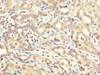 IHC image of CSB-PA002268LA01HU diluted at 1:200 and staining in paraffin-embedded human liver cancer performed on a Leica BondTM system. After dewaxing and hydration, antigen retrieval was mediated by high pressure in a citrate buffer (pH 6.0) . Section was blocked with 10% normal goat serum 30min at RT. Then primary antibody (1% BSA) was incubated at 4°C overnight. The primary is detected by a biotinylated secondary antibody and visualized using an HRP conjugated SP system.
