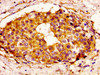 IHC image of CSB-PA002623LA01HU diluted at 1:100 and staining in paraffin-embedded human breast cancer performed on a Leica BondTM system. After dewaxing and hydration, antigen retrieval was mediated by high pressure in a citrate buffer (pH 6.0) . Section was blocked with 10% normal goat serum 30min at RT. Then primary antibody (1% BSA) was incubated at 4°C overnight. The primary is detected by a biotinylated secondary antibody and visualized using an HRP conjugated SP system.