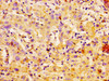 IHC image of CSB-PA004372LA01HU diluted at 1:100 and staining in paraffin-embedded human liver cancer performed on a Leica BondTM system. After dewaxing and hydration, antigen retrieval was mediated by high pressure in a citrate buffer (pH 6.0) . Section was blocked with 10% normal goat serum 30min at RT. Then primary antibody (1% BSA) was incubated at 4°C overnight. The primary is detected by a biotinylated secondary antibody and visualized using an HRP conjugated SP system.