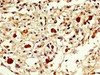 IHC image of CSB-PA007889LA01HU diluted at 1:300 and staining in paraffin-embedded human melanoma performed on a Leica BondTM system. After dewaxing and hydration, antigen retrieval was mediated by high pressure in a citrate buffer (pH 6.0) . Section was blocked with 10% normal goat serum 30min at RT. Then primary antibody (1% BSA) was incubated at 4°C overnight. The primary is detected by a biotinylated secondary antibody and visualized using an HRP conjugated SP system.