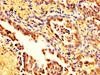 IHC image of CSB-PA01189A0Rb diluted at 1:200 and staining in paraffin-embedded human lung cancer performed on a Leica BondTM system. After dewaxing and hydration, antigen retrieval was mediated by high pressure in a citrate buffer (pH 6.0) . Section was blocked with 10% normal goat serum 30min at RT. Then primary antibody (1% BSA) was incubated at 4°C overnight. The primary is detected by a biotinylated secondary antibody and visualized using an HRP conjugated SP system.