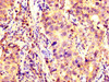 IHC image of CSB-PA012013LA01HU diluted at 1:200 and staining in paraffin-embedded human pancreatic cancer performed on a Leica BondTM system. After dewaxing and hydration, antigen retrieval was mediated by high pressure in a citrate buffer (pH 6.0) . Section was blocked with 10% normal goat serum 30min at RT. Then primary antibody (1% BSA) was incubated at 4°C overnight. The primary is detected by a biotinylated secondary antibody and visualized using an HRP conjugated SP system.