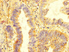 IHC image of CSB-PA012352LA01HU diluted at 1:400 and staining in paraffin-embedded human colon cancer performed on a Leica BondTM system. After dewaxing and hydration, antigen retrieval was mediated by high pressure in a citrate buffer (pH 6.0) . Section was blocked with 10% normal goat serum 30min at RT. Then primary antibody (1% BSA) was incubated at 4°C overnight. The primary is detected by a biotinylated secondary antibody and visualized using an HRP conjugated SP system.