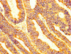 IHC image of CSB-PA013053LA01HU diluted at 1:200 and staining in paraffin-embedded human colon cancer performed on a Leica BondTM system. After dewaxing and hydration, antigen retrieval was mediated by high pressure in a citrate buffer (pH 6.0) . Section was blocked with 10% normal goat serum 30min at RT. Then primary antibody (1% BSA) was incubated at 4°C overnight. The primary is detected by a biotinylated secondary antibody and visualized using an HRP conjugated SP system.