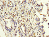 IHC image of CSB-PA013329LA01HU diluted at 1:200 and staining in paraffin-embedded human lung cancer performed on a Leica BondTM system. After dewaxing and hydration, antigen retrieval was mediated by high pressure in a citrate buffer (pH 6.0) . Section was blocked with 10% normal goat serum 30min at RT. Then primary antibody (1% BSA) was incubated at 4°C overnight. The primary is detected by a biotinylated secondary antibody and visualized using an HRP conjugated SP system.