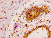 IHC image of CSB-PA013428LA01HU diluted at 1:100 and staining in paraffin-embedded human breast cancer performed on a Leica BondTM system. After dewaxing and hydration, antigen retrieval was mediated by high pressure in a citrate buffer (pH 6.0) . Section was blocked with 10% normal goat serum 30min at RT. Then primary antibody (1% BSA) was incubated at 4°C overnight. The primary is detected by a biotinylated secondary antibody and visualized using an HRP conjugated SP system.