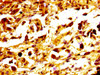 IHC image of CSB-PA013558LA01HU diluted at 1:400 and staining in paraffin-embedded human melanoma performed on a Leica BondTM system. After dewaxing and hydration, antigen retrieval was mediated by high pressure in a citrate buffer (pH 6.0) . Section was blocked with 10% normal goat serum 30min at RT. Then primary antibody (1% BSA) was incubated at 4°C overnight. The primary is detected by a biotinylated secondary antibody and visualized using an HRP conjugated SP system.