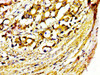 IHC image of CSB-PA015055LA01HU diluted at 1:400 and staining in paraffin-embedded human gastric cancer performed on a Leica BondTM system. After dewaxing and hydration, antigen retrieval was mediated by high pressure in a citrate buffer (pH 6.0) . Section was blocked with 10% normal goat serum 30min at RT. Then primary antibody (1% BSA) was incubated at 4°C overnight. The primary is detected by a biotinylated secondary antibody and visualized using an HRP conjugated SP system.