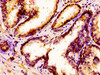 IHC image of CSB-PA015068LA01HU diluted at 1:300 and staining in paraffin-embedded human prostate cancer performed on a Leica BondTM system. After dewaxing and hydration, antigen retrieval was mediated by high pressure in a citrate buffer (pH 6.0) . Section was blocked with 10% normal goat serum 30min at RT. Then primary antibody (1% BSA) was incubated at 4°C overnight. The primary is detected by a biotinylated secondary antibody and visualized using an HRP conjugated SP system.
